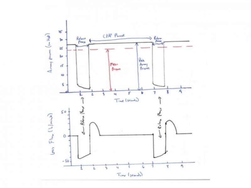 The basics of Airway Pressure Release Ventilation (APRV)