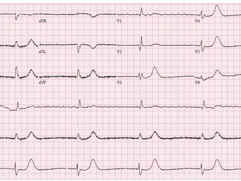Critical Cases - Bradycardia Emergency!