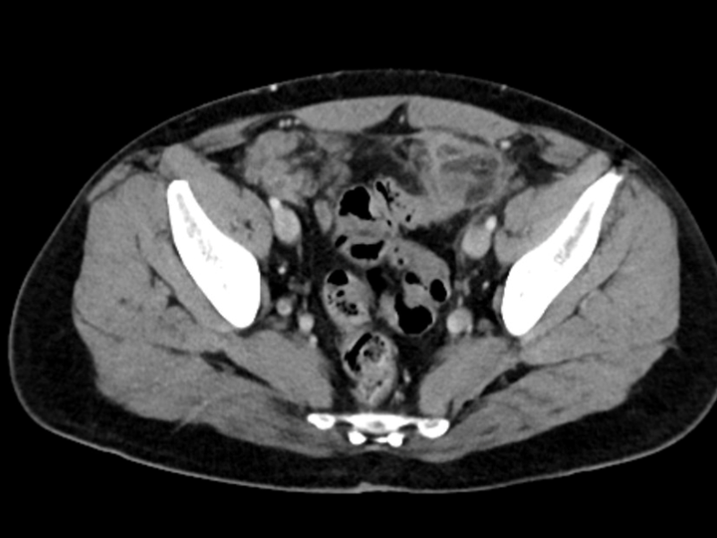 Advanced Cases - Complications of IBD!