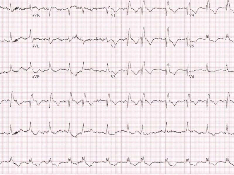 Critical Cases - Saddle Pulmonary Embolism!