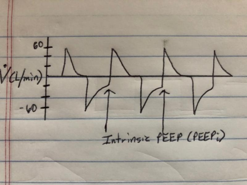 Ventilator graphic analysis: Obstructive lung disease