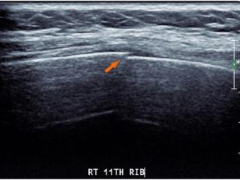 Rib Fractures Part 1: Dr. DeMarzo