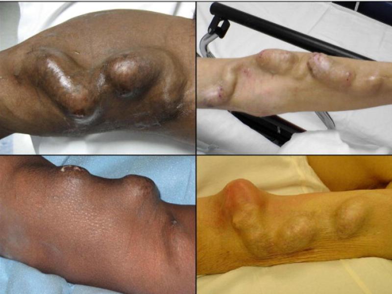 Critical Cases - Fistula Hemorrhage Emergency!