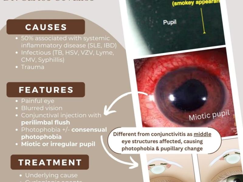 Uveitis and Iritis with Dr. Carlos Cevallos