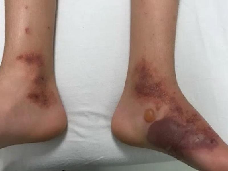 Back to Basics: A common rash