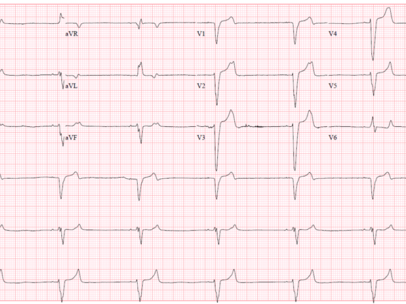 From the EMDaily Archives: BRASH Syndrome by Dr. Richard Byrne