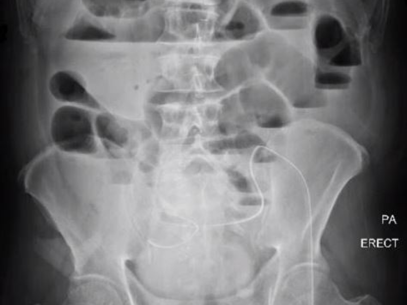 Abdominal Aortic Ultrasound Review  By Dr. Ciervo