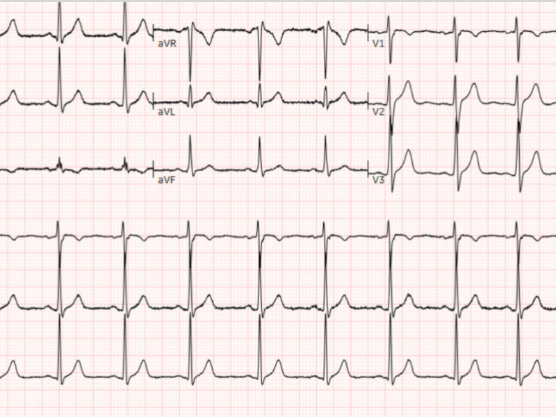 Critical Cases - Diaphragmatic Hernia!!!