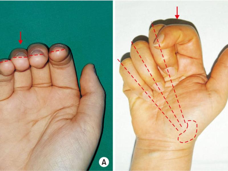 Advanced Cases: Metacarpal Fractures