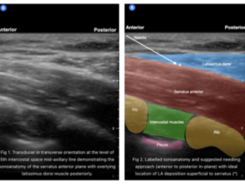 Rib Fractures part 2/Serratus Anterior Nerve Block: By Dr. DeMarzo